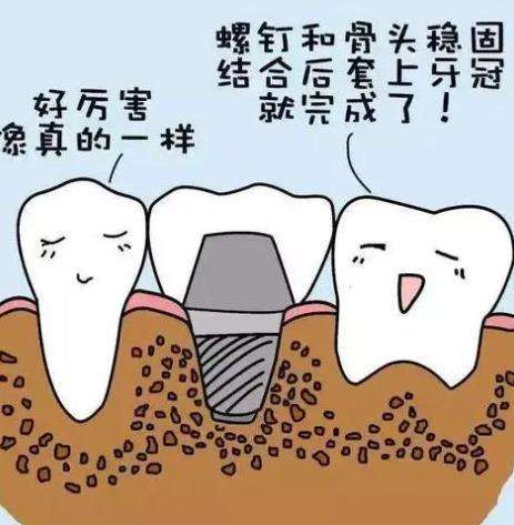 台州种一颗牙大概要多少钱？植牙方式分析如下