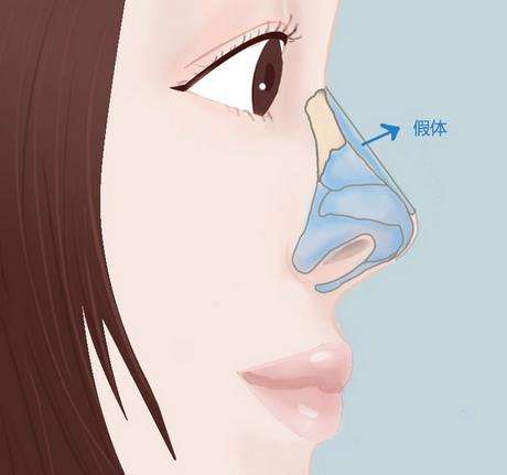 假体隆鼻后鼻子不能捏的主要原因是什么？