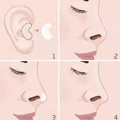 耳软骨隆鼻的原理？耳软骨隆鼻适用于哪些人群?