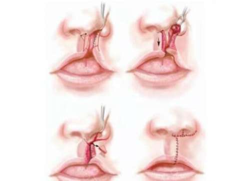 唇腭裂手术图片，唇腭裂现在手术效果怎么样？术后注意事项一览