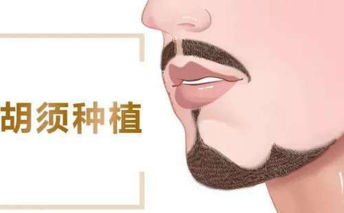 什么是胡须种植？胡须种植多少钱