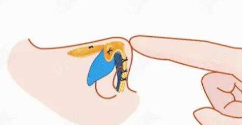 隆鼻 隆鼻