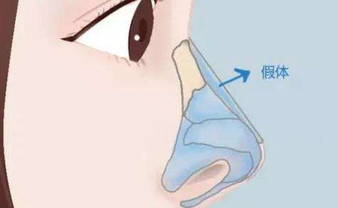 隆鼻53.jpg 隆鼻53.jpg