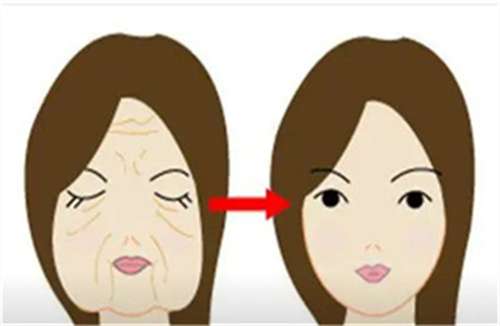 拉皮1.jpg