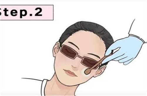 光子嫩肤3.jpg