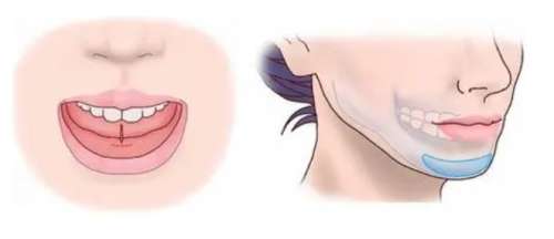 假体垫下巴.jpg