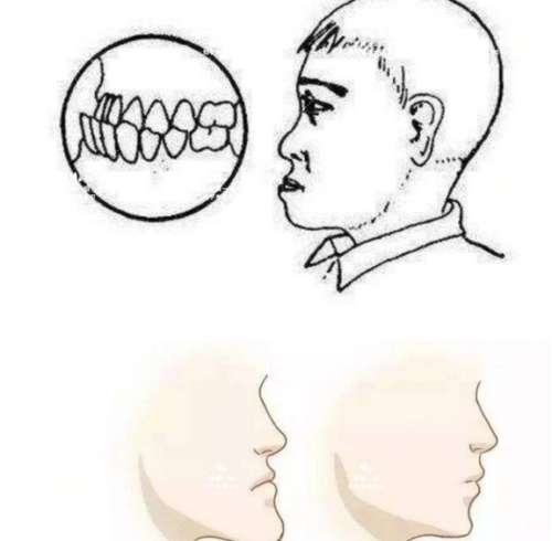 嘴凸手术.jpg