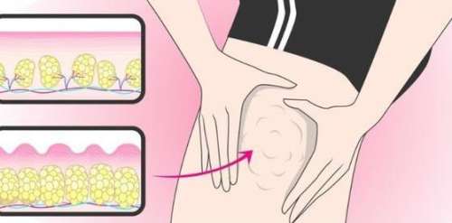 大腿吸脂