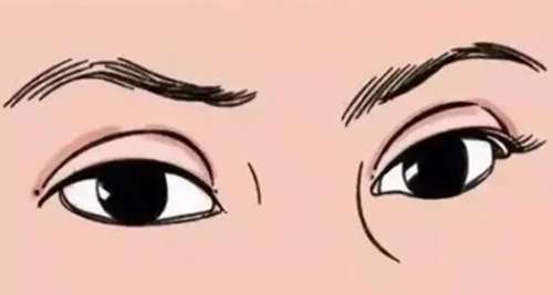 双眼皮做宽了04.jpg