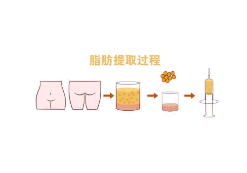 沈阳医大一院自体脂肪填充怎么样？郭澍20从业经验，技术扎实