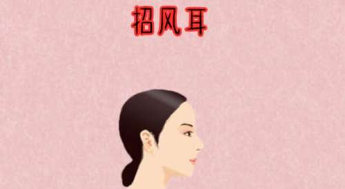招风耳整形02.jpg