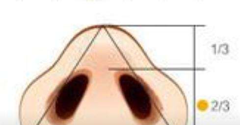 隆鼻 隆鼻