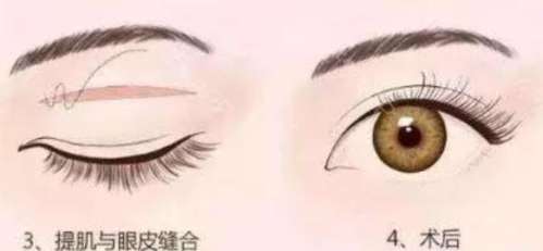双眼皮 双眼皮