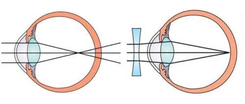 近视眼矫正