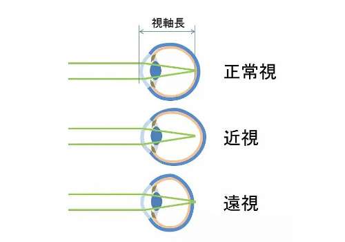 700度可以做近视手术吗？适合哪类近视手术呢？注意事项有哪些？