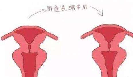 私密紧缩 私密紧缩