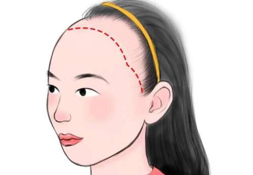 发际线种植 发际线种植