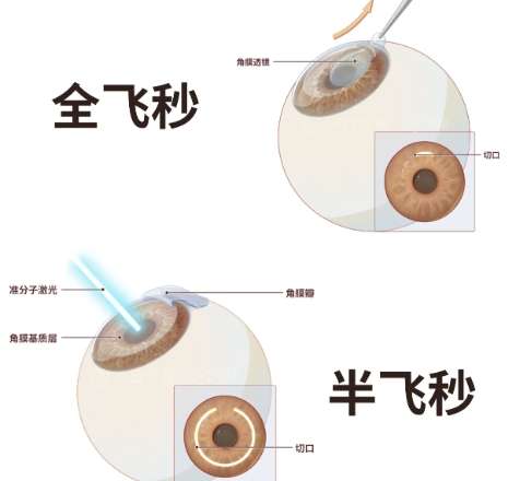 近视眼 近视眼