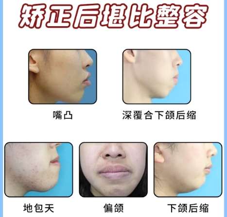 牙齿矫正 牙齿矫正