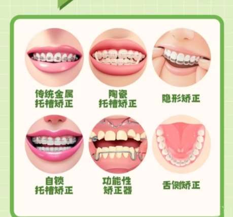 牙齿矫正 牙齿矫正