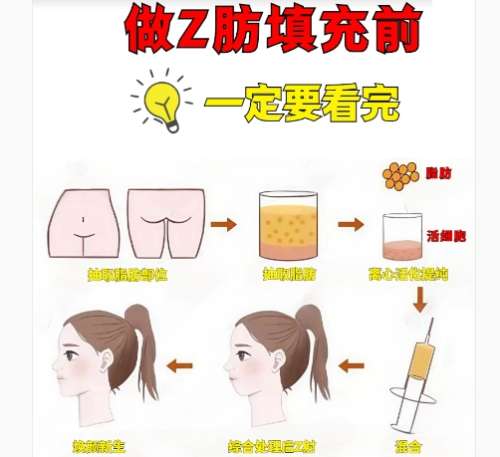 脂肪填充 脂肪填充