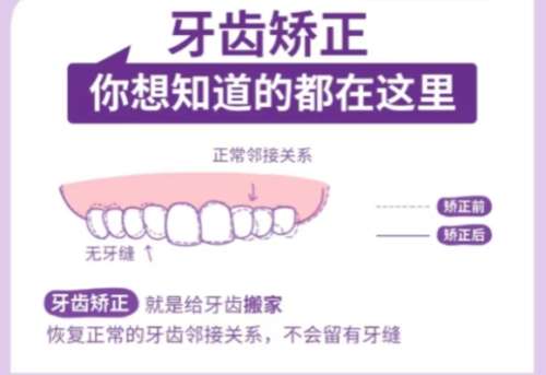 牙齿矫正 牙齿矫正