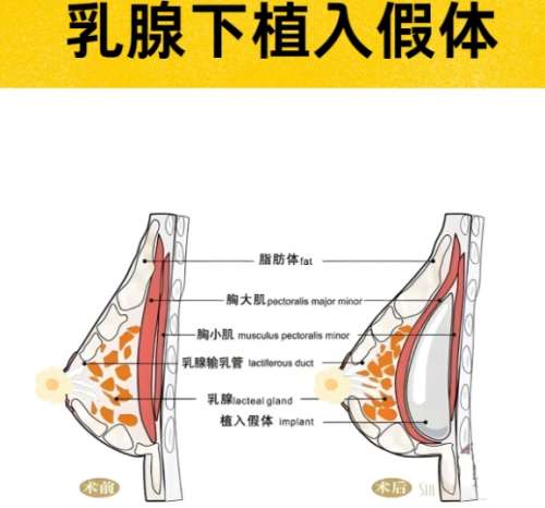 隆胸 隆胸