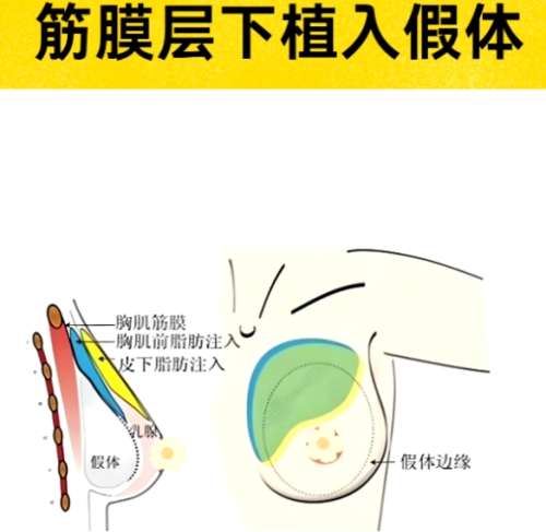 隆胸 隆胸