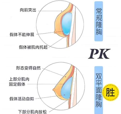 隆胸 隆胸