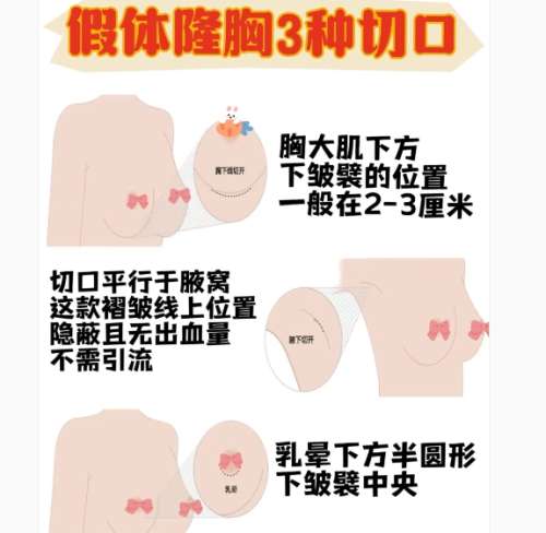 隆胸 隆胸