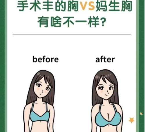 隆胸 隆胸