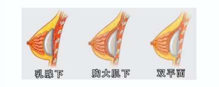 隆胸 隆胸