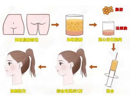 自体脂肪填充