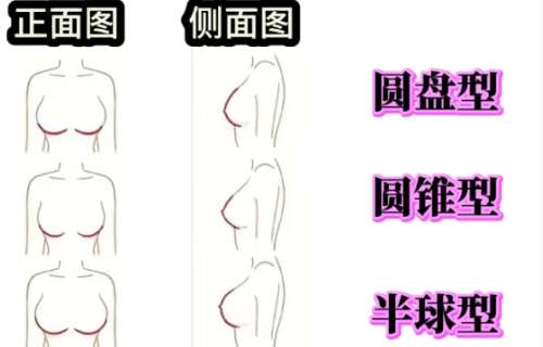 隆胸 隆胸