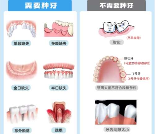牙齿种植 牙齿种植