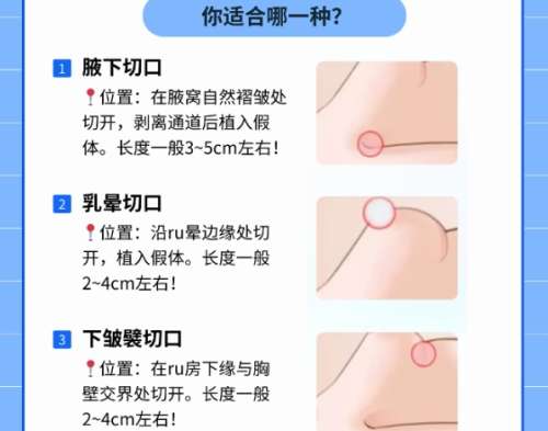 隆胸 隆胸