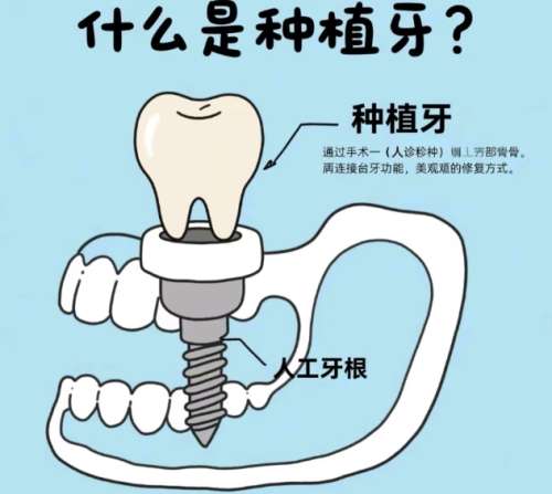 牙齿种植 牙齿种植
