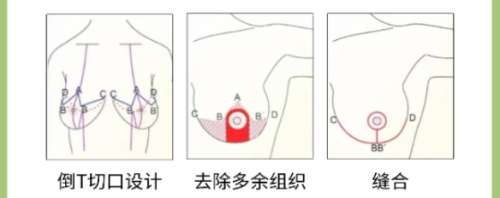 隆胸 隆胸