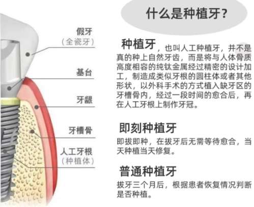 牙齿种植 牙齿种植