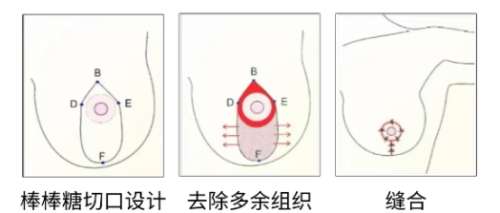 隆胸 隆胸