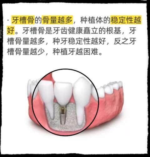 牙齿种植 牙齿种植