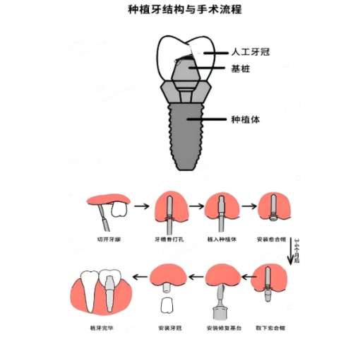 牙齿种植 牙齿种植