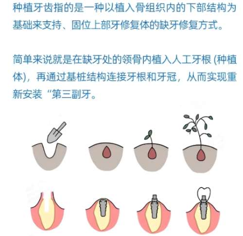 牙齿种植 牙齿种植