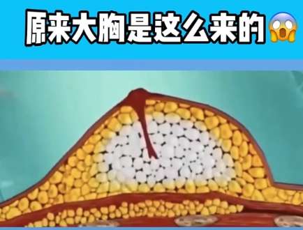 隆胸 隆胸