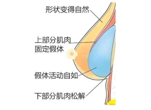 隆胸 隆胸