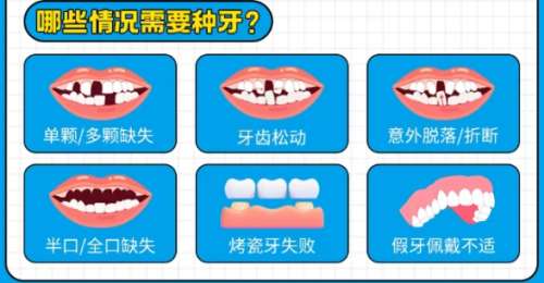 牙齿种植 牙齿种植