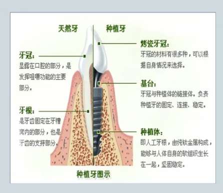 牙齿种植 牙齿种植