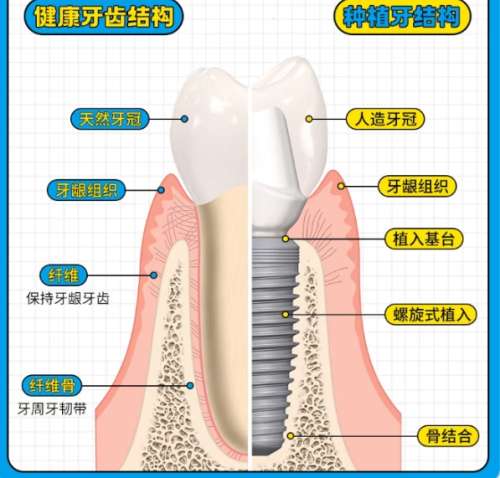 牙齿种植 牙齿种植