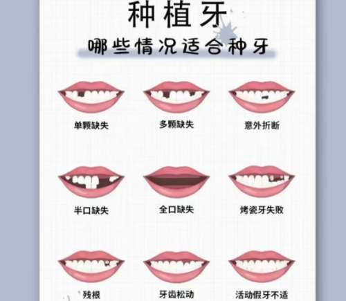 牙齿种植 牙齿种植