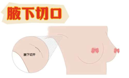 隆胸 隆胸